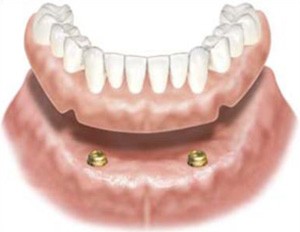 implant denture